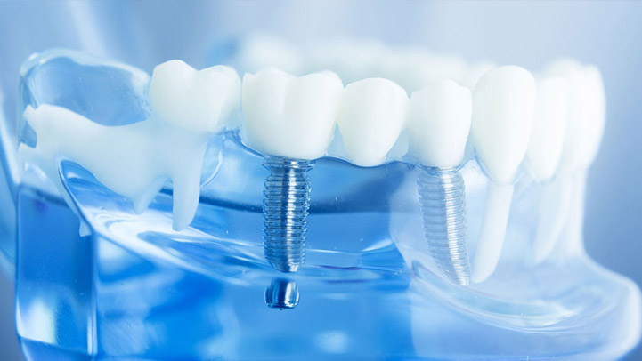 Implantate Zahntechnik Dentallabor Aachen